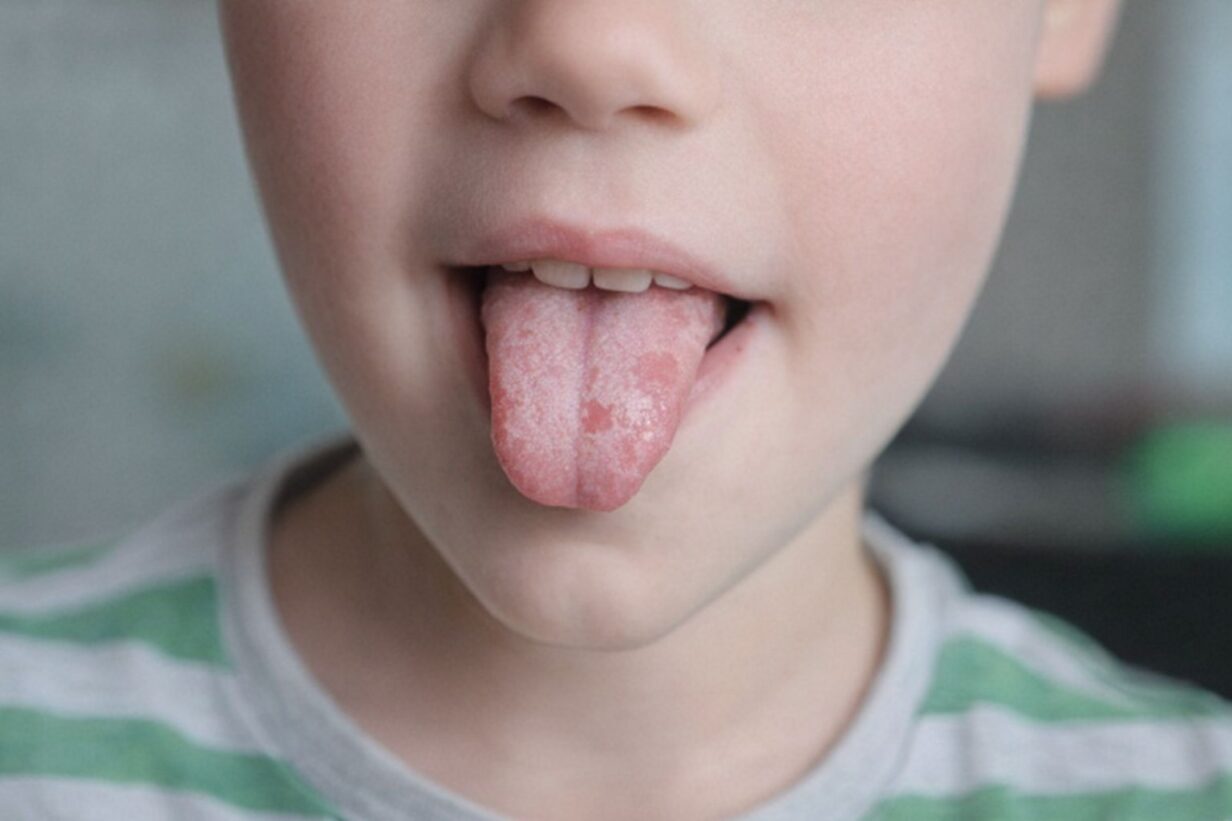 Närbild på ett barn som sträcker ut tungan med tydliga fläckar av geografisk tunga.